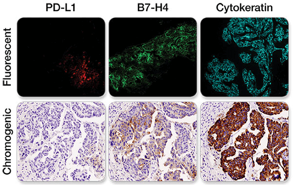 IHCの染色例 PDL1 B7H4 Cytokeratin